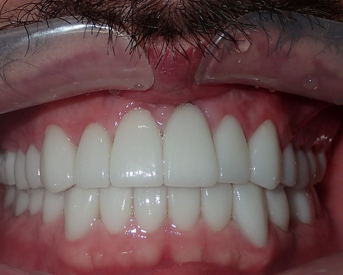 Dental Implants - after