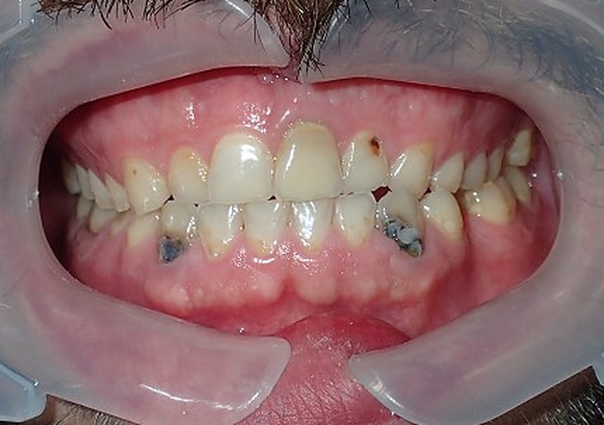 Dental Implants - before