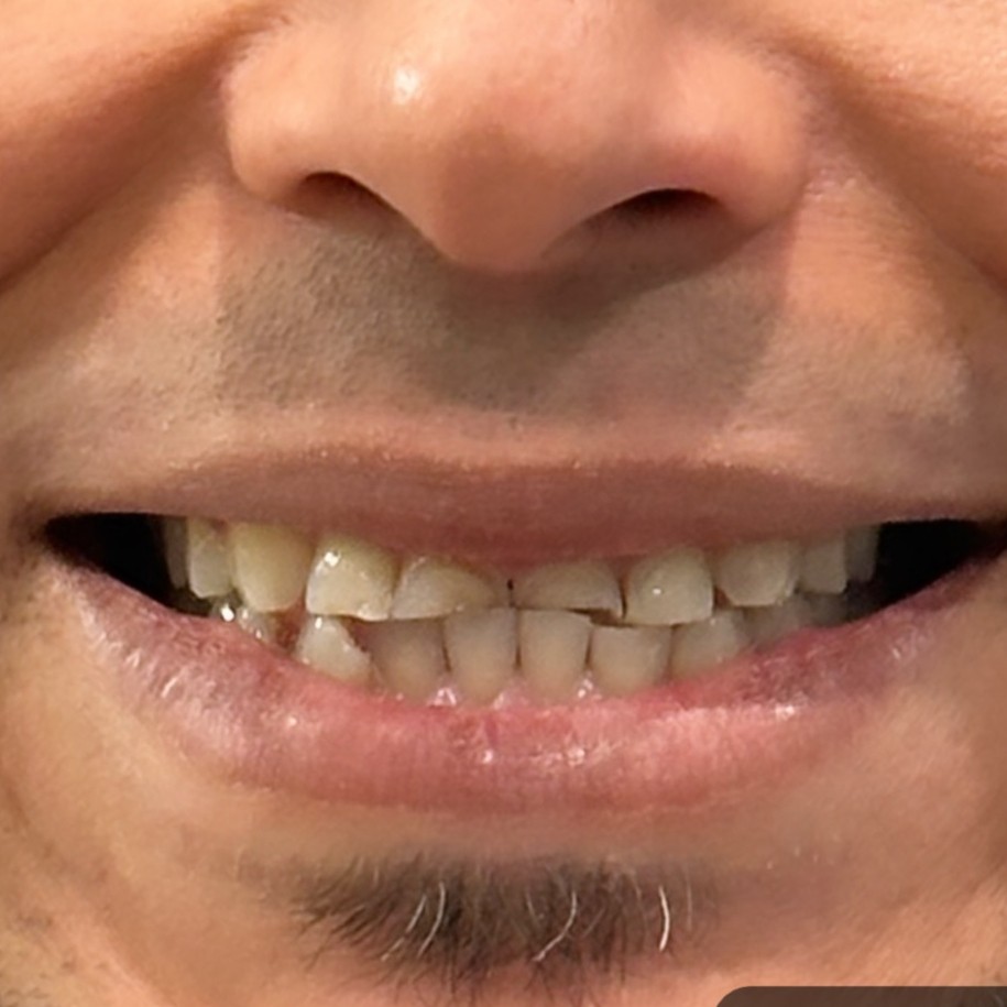 Full Mouth Restoration - before