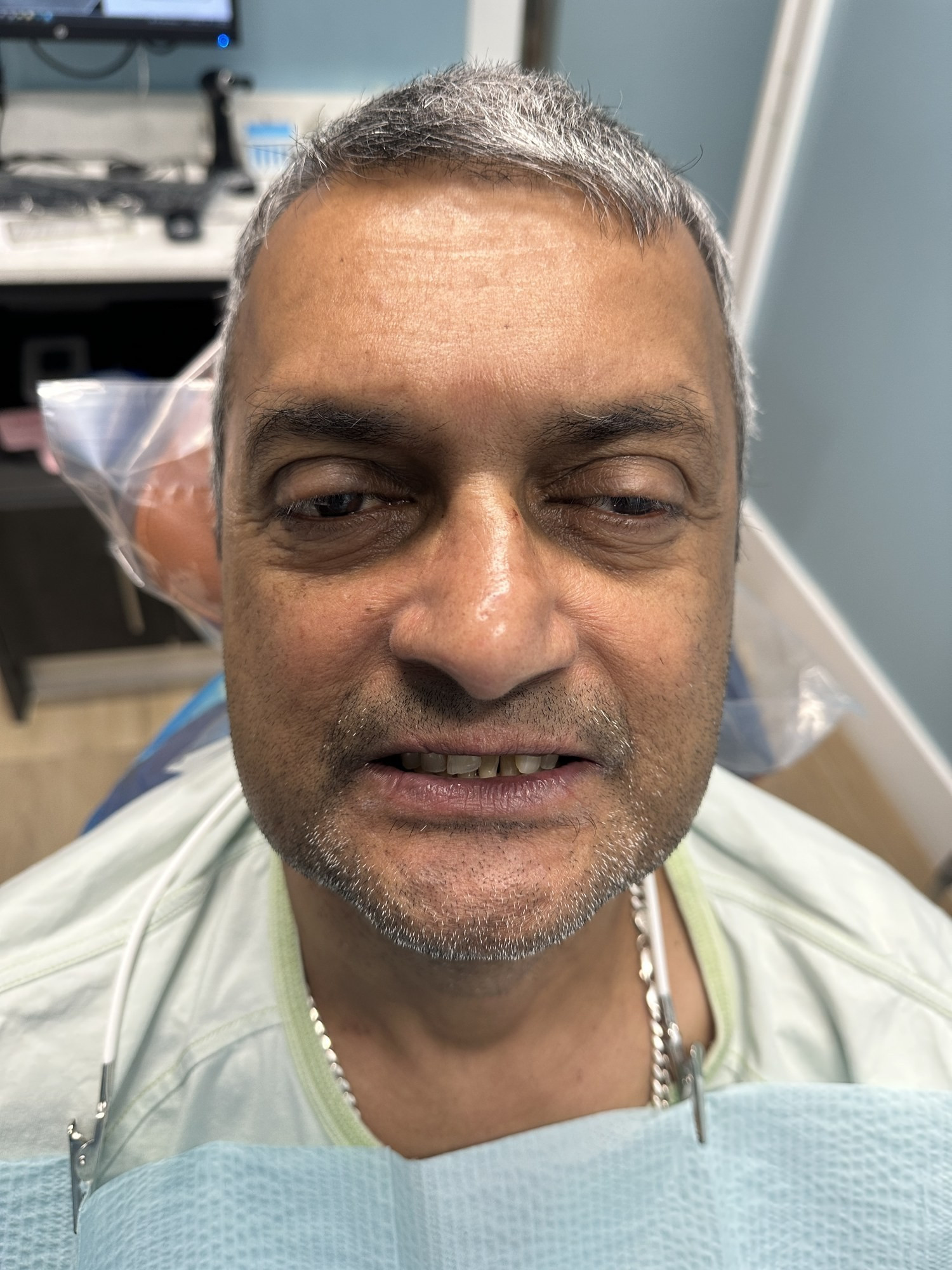 Full Mouth Restoration - before