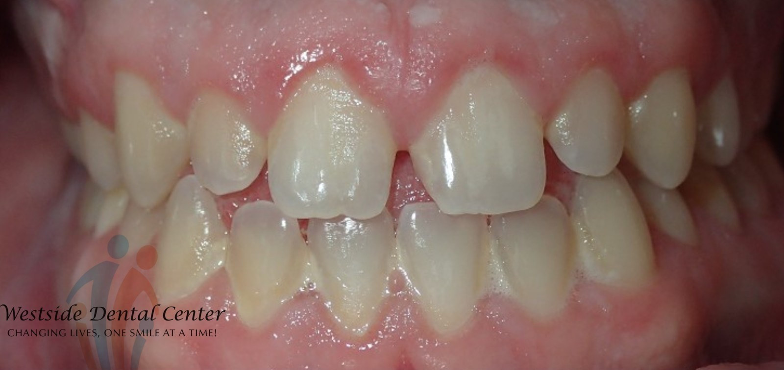 Veneers - before