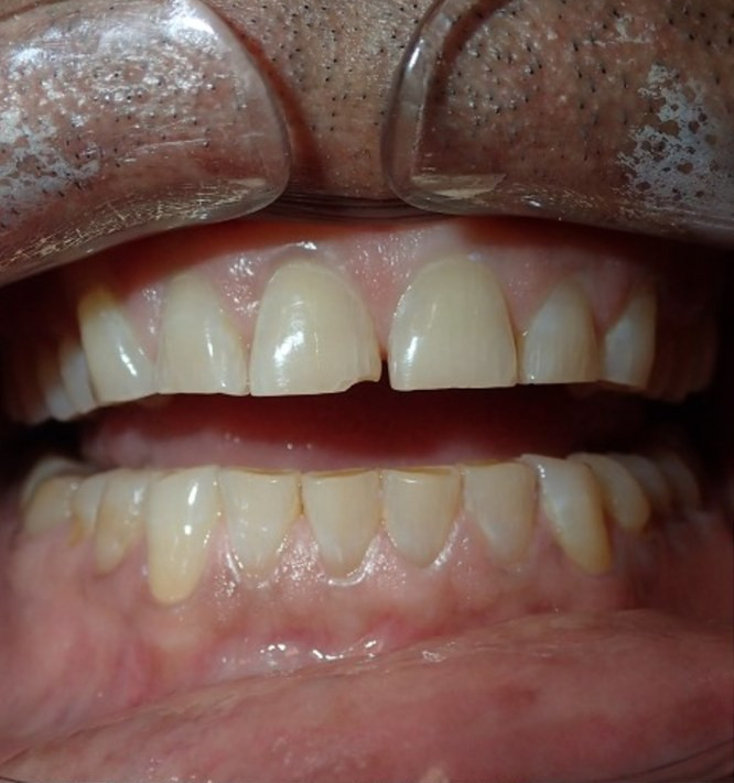 Full Mouth Restoration - before