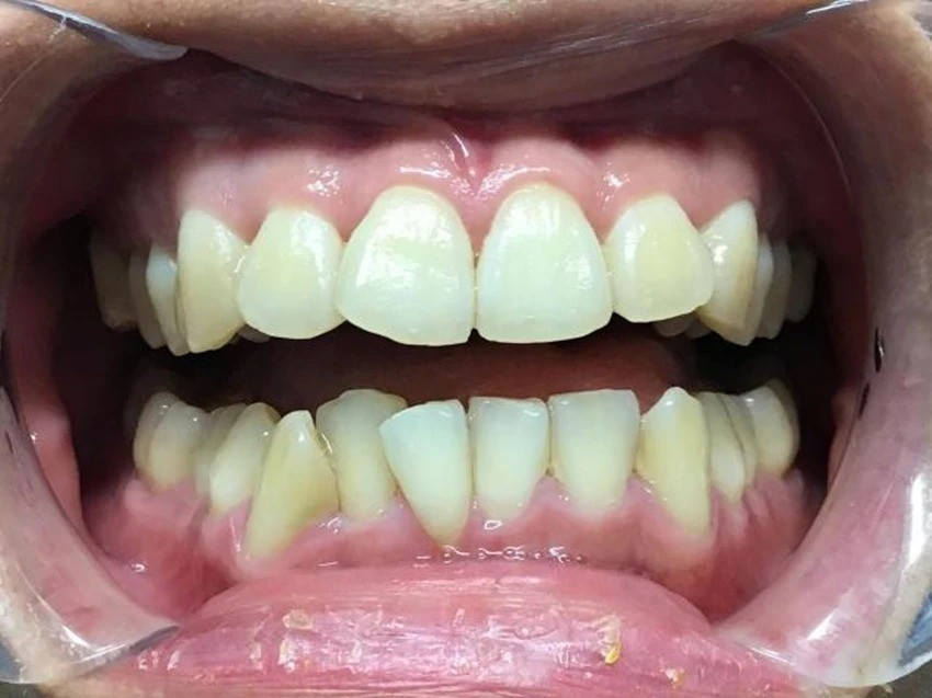 Invisalign - before