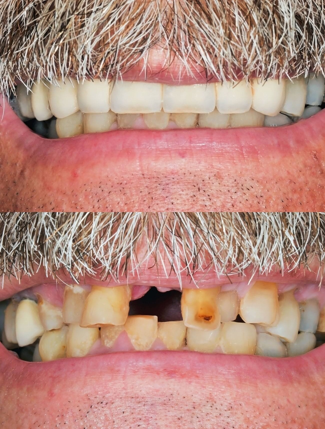 why-do-i-need-to-replace-my-missing-teeth-plantation-fl